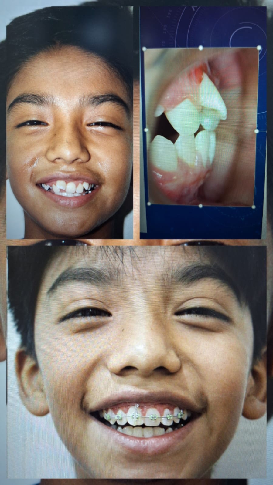 Caso de ortodoncia infantil