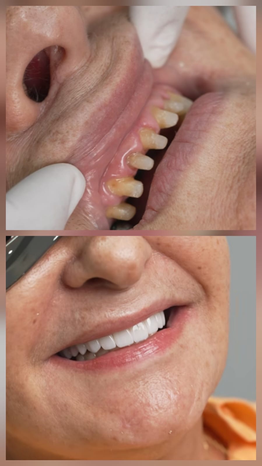 Resultado dental en adulto