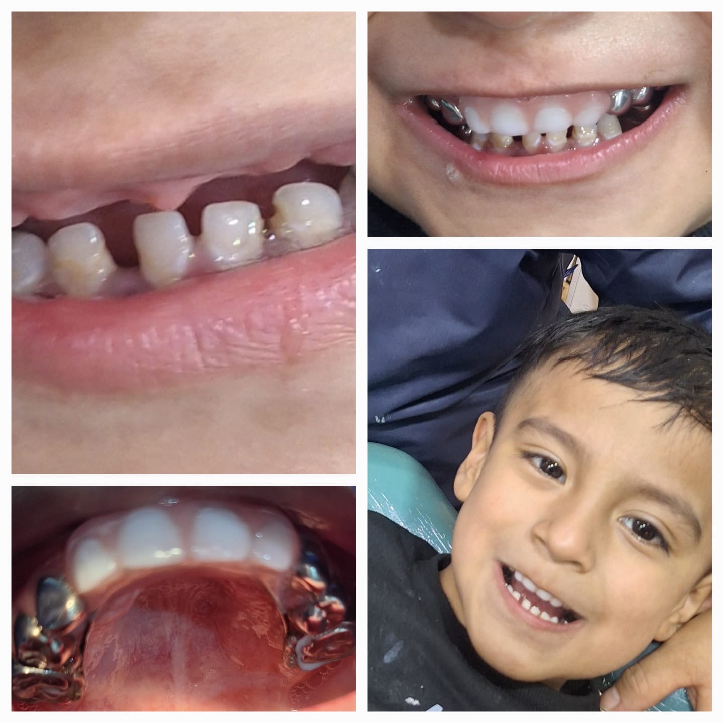 Caso pediátrico dental