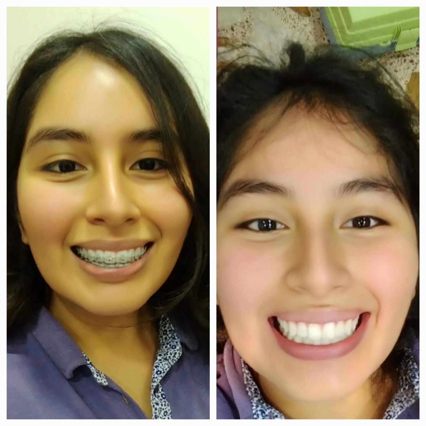 Resultado de ortodoncia